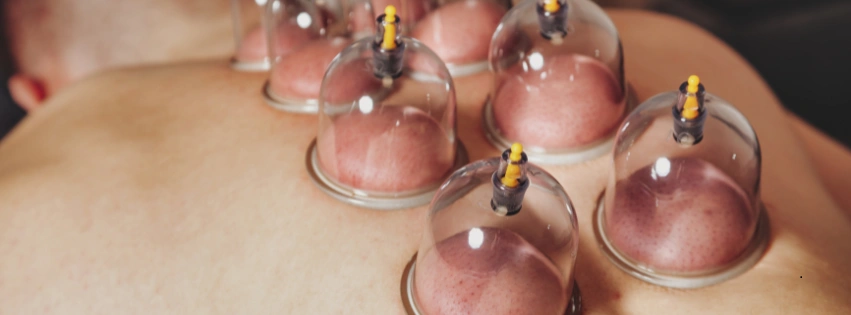 Cupping Therapy Physiotherapy in Bangalore - Clinical Pain Relief